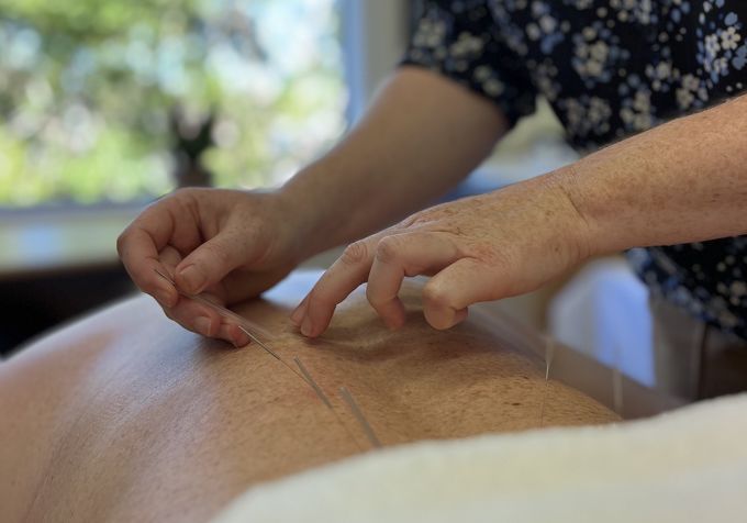 Person receiving acupuncture treatment on back